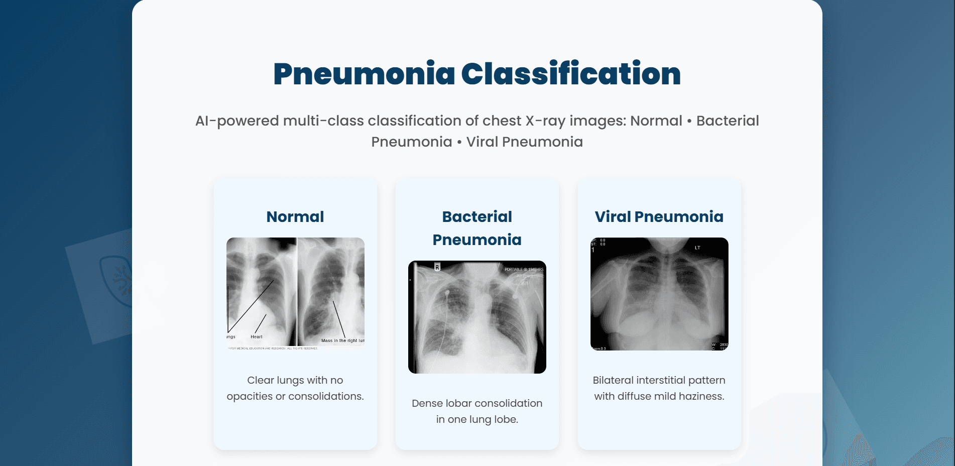 Pneumonia Detection — Computer Vision